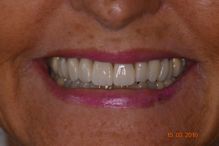 Facings in de Cosmetische Tandheelkunde Tandheelkundig centrum abcoude